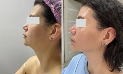 Дермотония FULLSKIN